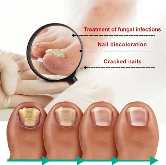 Nail Fungus Treatment -Advanced Antifungal Treatment
