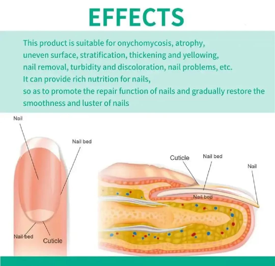 Nail Fungus Treatment -Advanced Antifungal Treatment