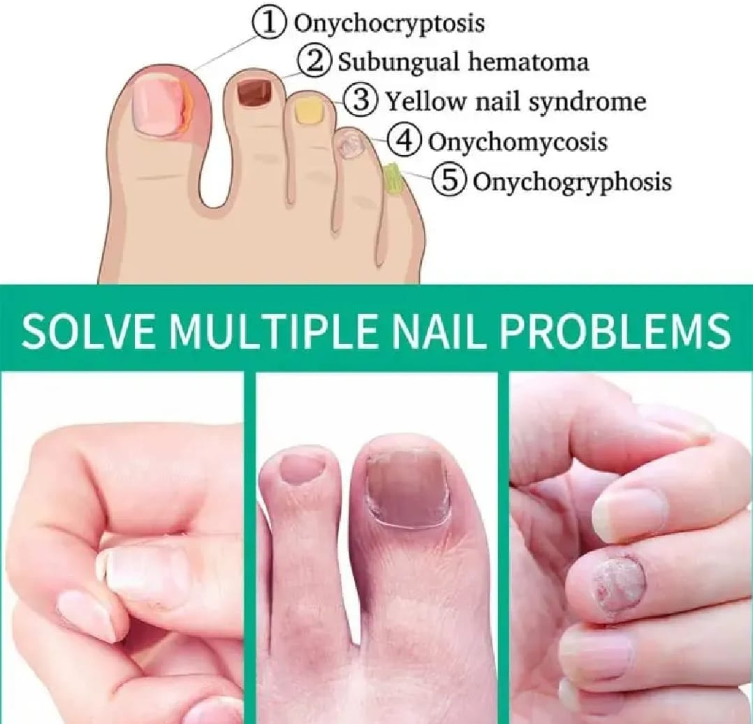 Nail Fungus Treatment -Advanced Antifungal Treatment